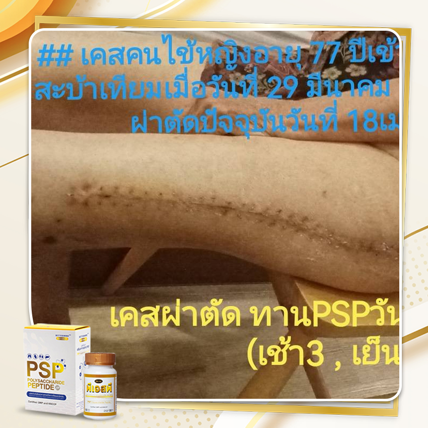 PSP WEB BN รีวิวเคสผ่าตัด 3