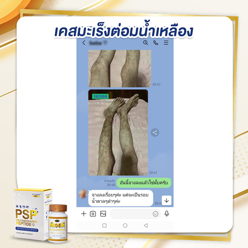 PSP WEB BN รีวิวเคสมะเร็ง 5