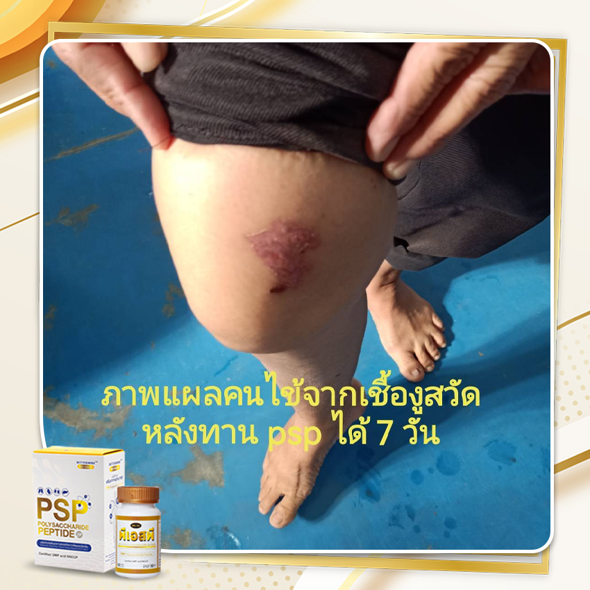 PSP WEB BN รีวิวเคสเชื้องูสวัด 2